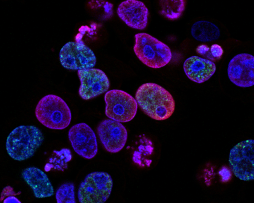 Axicabtagene ciloleucel en el linfoma de células B grandes no apto para trasplante autólogo de células madre: el ensayo ALYCANTE de fase 2